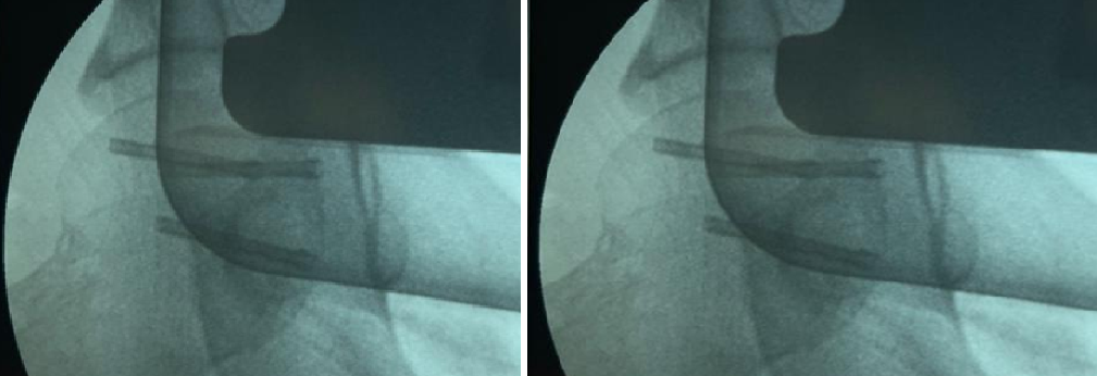 Interoperative image showing femoral head fixation with 3mm herbert screws