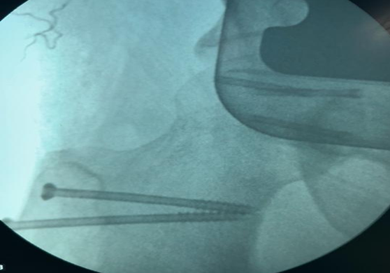 The greater trochanter flap was relocated and secured with three 6mm screws