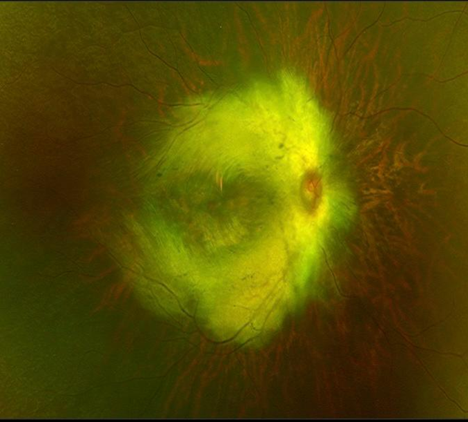 Fundus image showing symmetrical concentricmyelinated nerve fibers involving macula contiguous with optic disc in right eye.