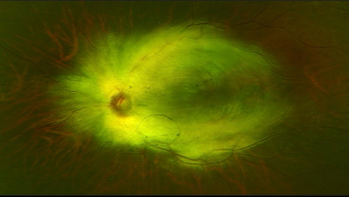 Fundus image showing symmetrical concentricmyelinated nerve fibers involving macula contiguous with the optic disc in the left eye