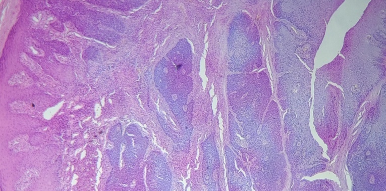 Photomicrograph of Basal cell carcinoma (100X)