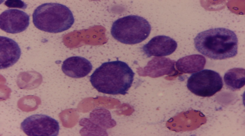Blastic precursors were large cells with oval to irregular nucleus with coarse granular chromatin with 1-2 prominent nucleoli and scant granular blue cytoplasm. Haematoxylin and Eosin x 100X.