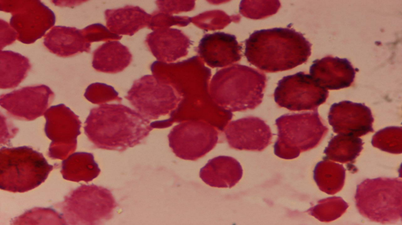 Cytochemical stain Myeloperoxidase (MPO) showed faint cytoplasmic positivity in few blasts. MPO x100X.