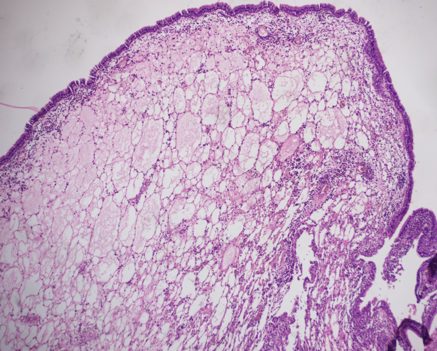 Polypoid fibrocollagenous tissue lined by pseudostratified ciliated columnar epithelium with marked oedema of the subepithelial stroma and ectatically dilated blood vessels(H&E at 40x).