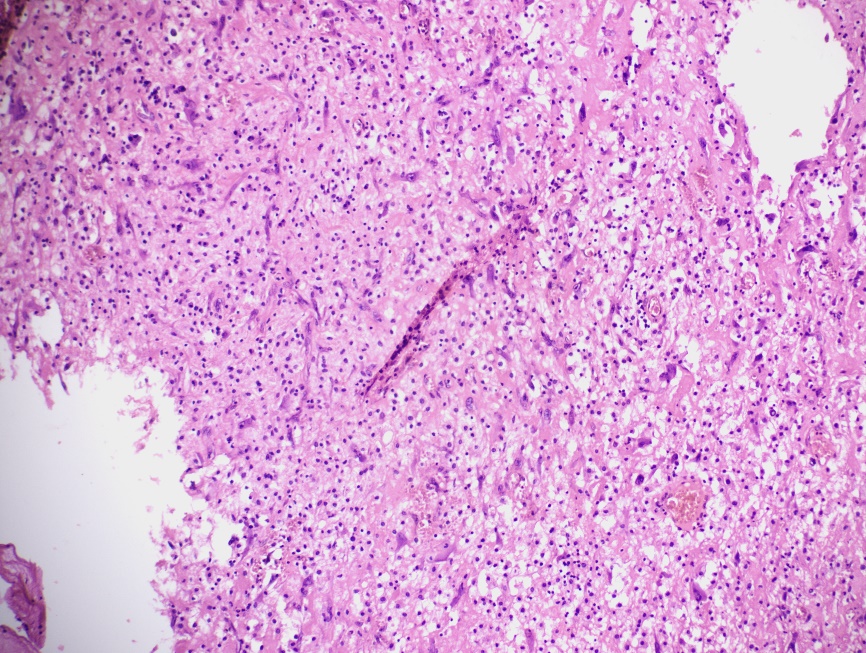 Stroma showing haphazard proliferation of atypical stroma cells(H&E at 100x)