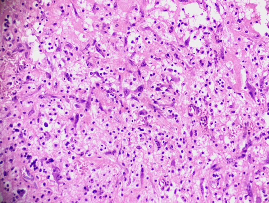 Markedly atypical stromal cells with prominent nucleoli(H&E at 200x)