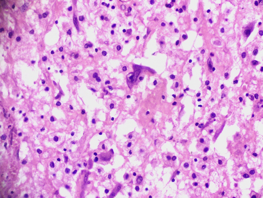 Markedly atypical stromal cells with prominent nucleoli (H&E at 400x)