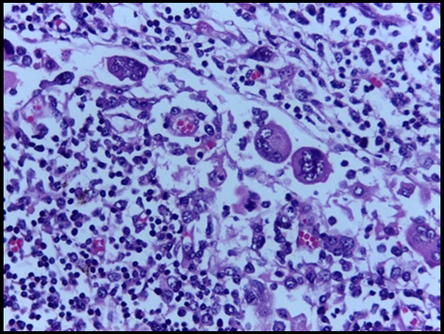 Lymph node at 400X expanded sinuses shows megakaryocytes, normoblasts admixed with lymphocytes.