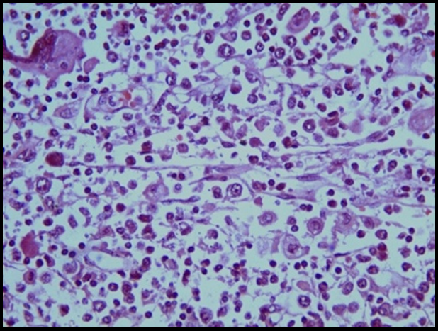 Lymphnode at 400X showing few myeloid cells and itβs precursors