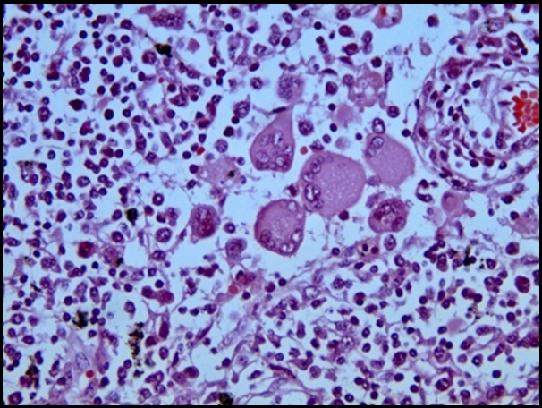 Lymphnode at 400X showing megakaryocytes, myeloid precursor cells and lymphocytes.