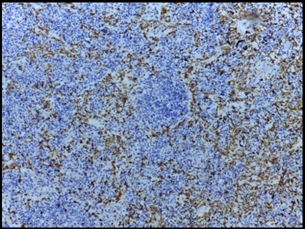 Lymphnode at 400X showing MPO positive cells within the sinuses.