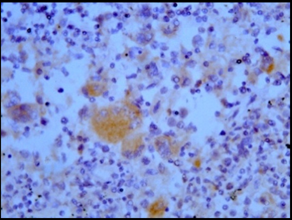 Lymph node at 400X showing CD61 positive megakaryocytes