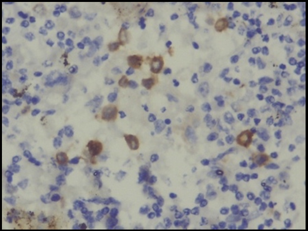 Lymphnode at 400X showing CD117 positive immature myeloid cells (blast)