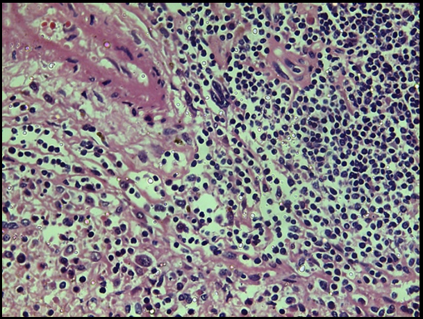 Spleen at 400X showing leukemic infiltrate in the white pulp