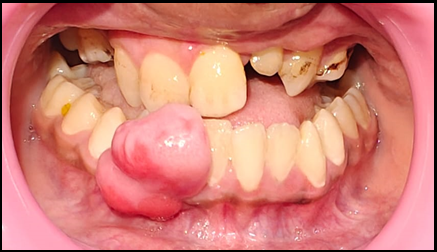 Extraoral view of lesion