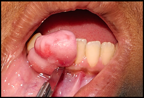 Excision of tissue with scalpel