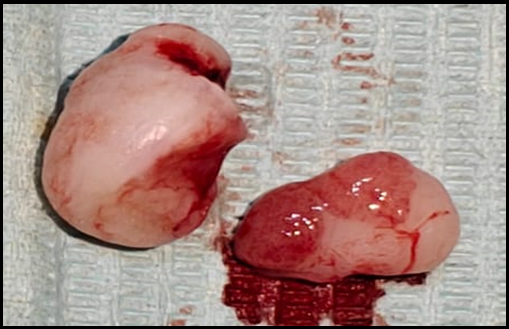 Excised tissue