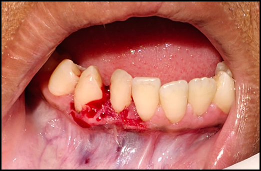 Immediate post-operative