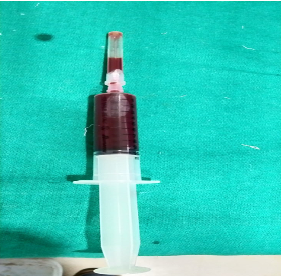 9 ml of blood aspirated from the swelling.