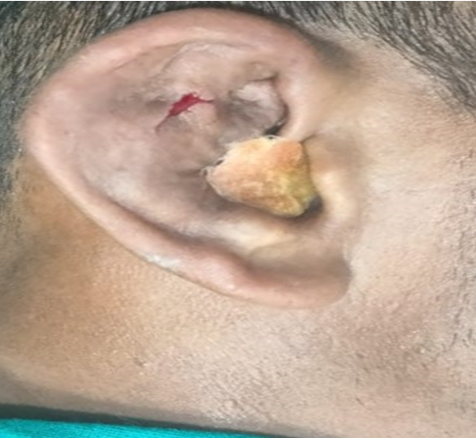 Incision and drainage done over the swelling on pinna.