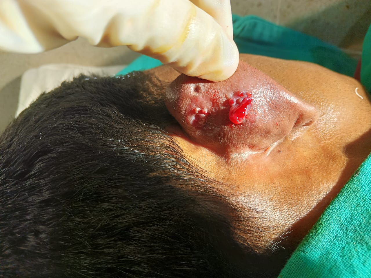 Wound status after 1 month (Patient was non compliant and followed after 1 month of post button suturing)