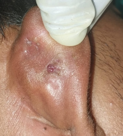 Wound status after 1.5 month (medial surface)