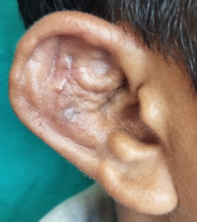 Wound status after 1.5 month (lateral surface) 