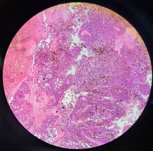Microscopic examination (4x) H&E stain showing neoplastic cells arranged in sheets and peritheliomatous pattern.