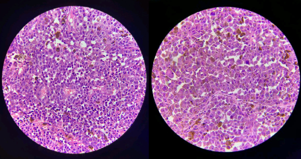 Microscopic examination (40x) H&E stain which shows melanin pigment.
