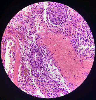 Microscopic examination (40x) H&E which shows that cells are epitheliod to spindle in nature.