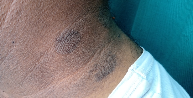 Acanthosis like chromic Pityriasis Versicolor