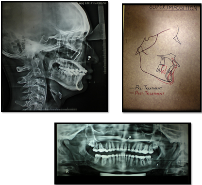 Post-treatment radiographs and superimposition