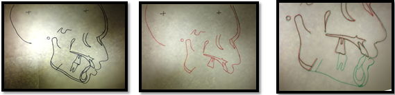 Pre-surgical prediction tracing