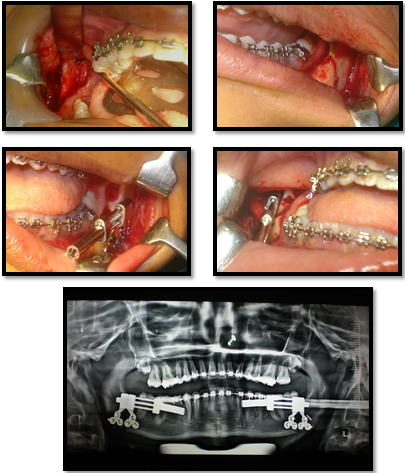 Intraoperative photographs and radiograph