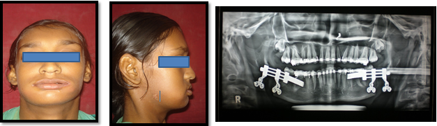 2 weeks post distraction photographs & OPG
