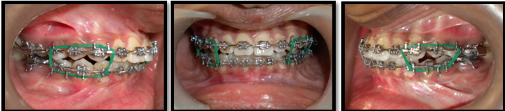 Post distraction settling of occlusion