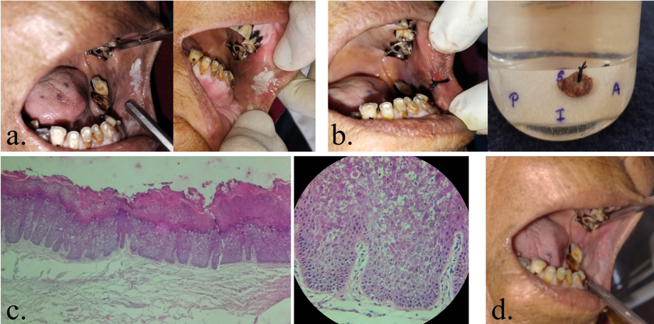 a: Intraoral; b: Post excision and specimen; c: Histopathological sections 4x and 40x respectively; d: Follow-up after 1 year