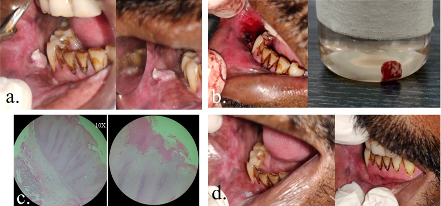 a: Intraoral; b: Post excision and specimen; c: Histopathological sections 4x and 10x respectively; d: Follow-up after 1year (Left) and 2 years (Right) respectively