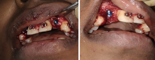 Intra-operative photographs (Implants placed)