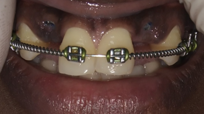 Healing after 6 month