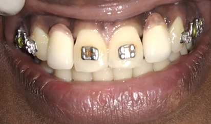 Post-operative photograph showing a restored smile