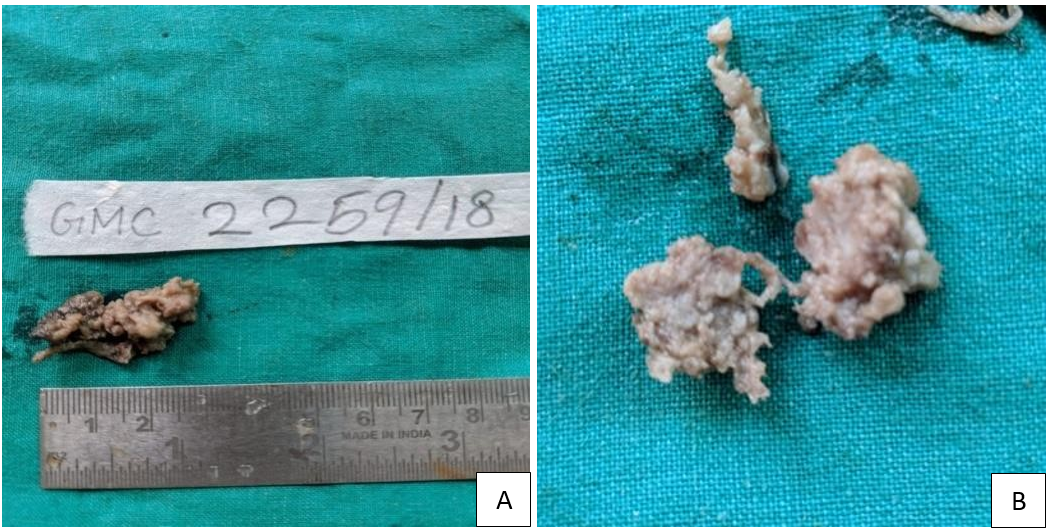 A, B: Multiple grey-brown soft tissue bits with surface showing minute papillary projections. Cut surface is grey-white