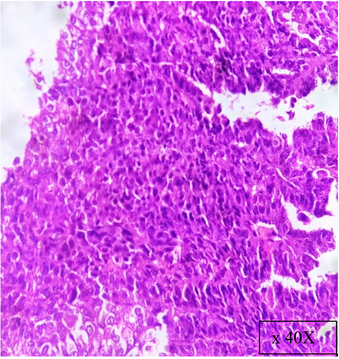 Histopathological examination showing tumour tissue arranged in sheets with increased cellularity, nuclear pleomorphism, frequent mitosis and necrosis