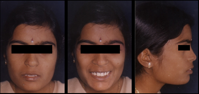 Pre treatment extraoral photographs