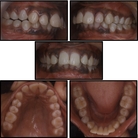 Pre treatment intraoral photographs