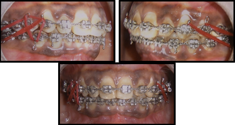 Pre finishing settling intraoral photographs
