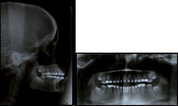Pre finishing x-rays