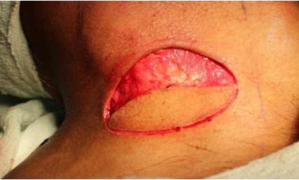Showing outline of skin paddle