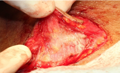 Dissection insubplatysmal plane