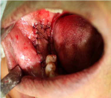  Flap sutured over band resected area